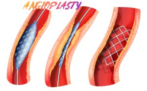 Coronary Angioplasty to coronary artery with DES