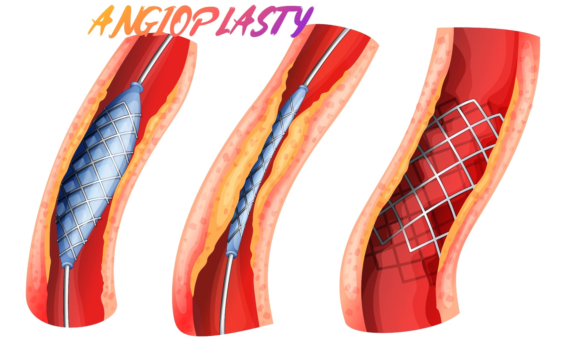 Angioplasty to coronary artery with DES or drug eluting stent in a blocked coronary artery