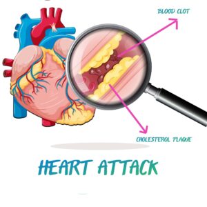 CORONARY ARTERY CLOGGED UP BY CHOLESTEROL AND A CLOT CAUSING A HEART ATTACK