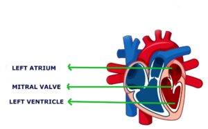 mitral valve stenosis