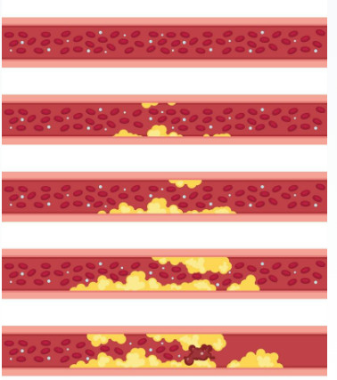 Coronary artery disease stages - plaque to rupture