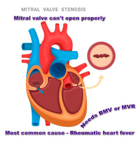 Severe mitral stenosis - caused by rheumatic fever, needs BMV or MVR