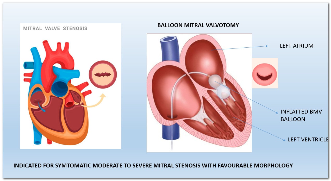 balloon mitral valvotomy for severe mitral stenosis (MS)