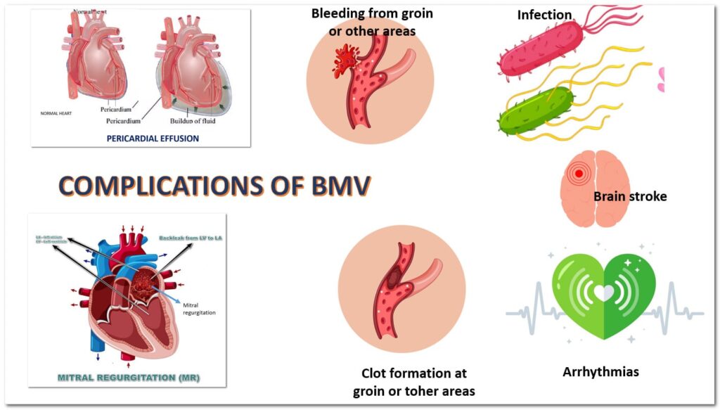 Complications of balloon mitral valvuloplasty such as brain stroke, bleeding, pericardial effusion