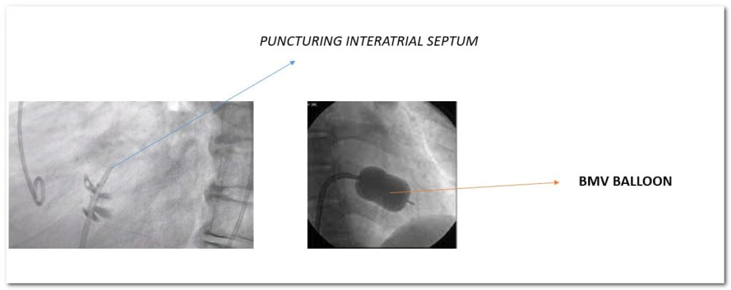 Percutaneous balloon mitral valvuloplasty for mitral stenosis