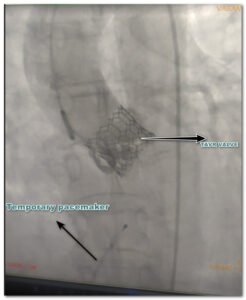 TAVR surgery for aortic stenosis