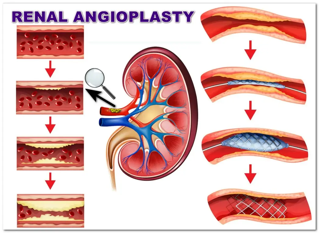 What is renal angioplasty