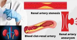 renal-angiogram-abnormalities -indications | renal artery stenosis-renal artery aneurysm- renal artery thrombosis