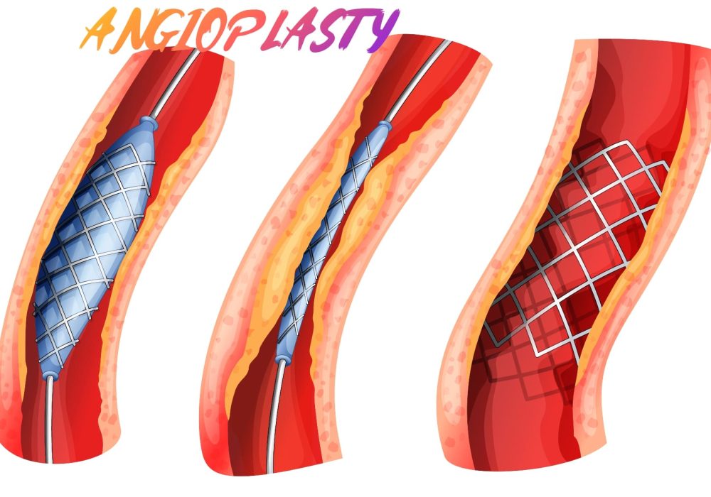 Coronary Angioplasty to coronary artery with DES