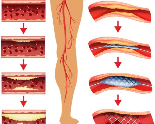 Peripheral angioplasty and Peripheral arterial disease