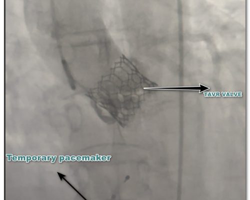 tavr surgery for aortic stenosis