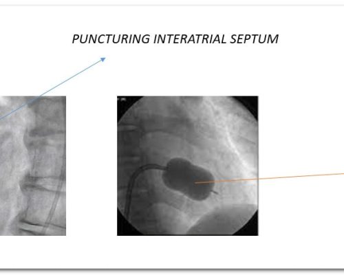 What is a percutaneous balloon mitral valvuloplasty for mitral stenosis