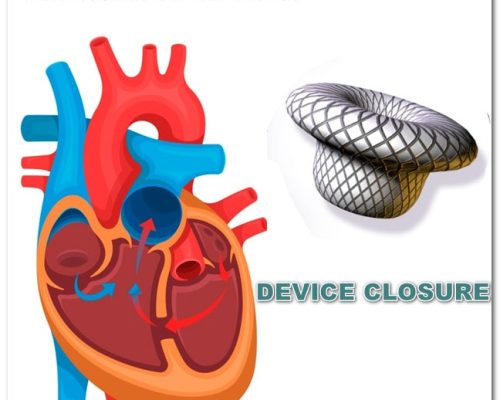 device closure procedure for AD, VSD and PDA