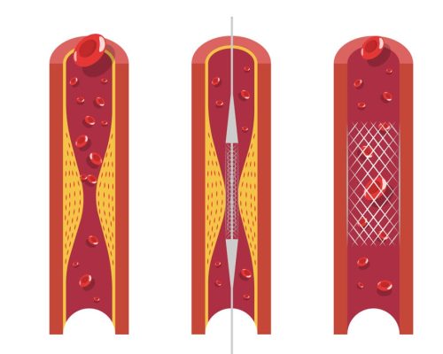 illustration of what is a coronary angioplasty